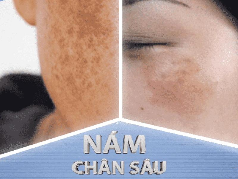 Top 6 kem trị nám chân sâu hiệu quả tại nhà, ngừa tái phát, không bong tróc- Ảnh 1. Top 6 kem trị nám chân sâu hiệu quả tại nhà, ngừa tái phát, không bong tróc- Ảnh 1.