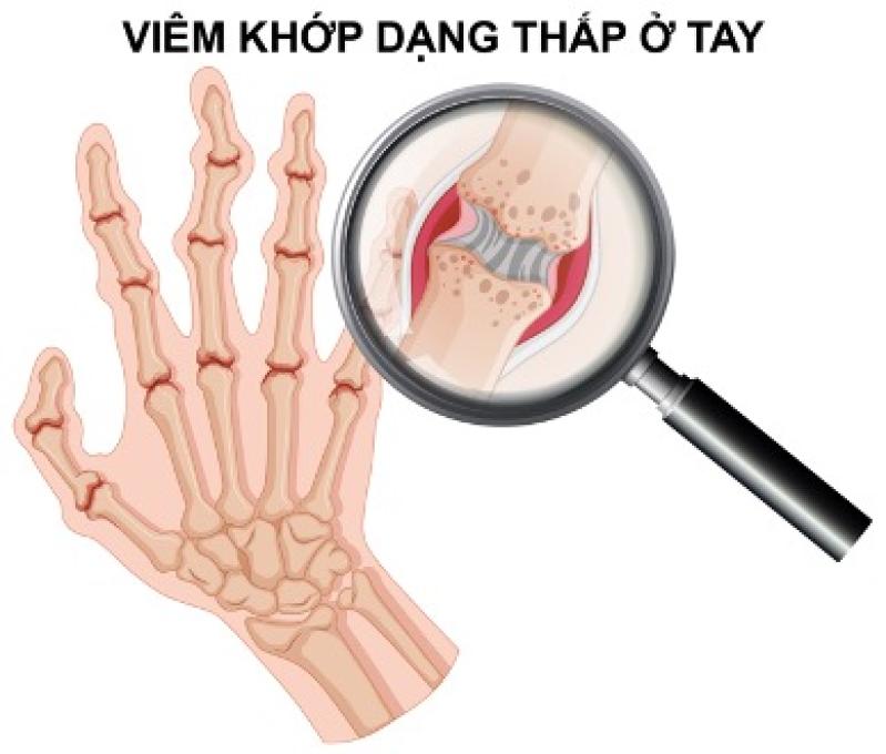 Alo bác sĩ nghe: Viêm khớp dạng thấp có thể chữa khỏi hoàn toàn không? - Ảnh 1.