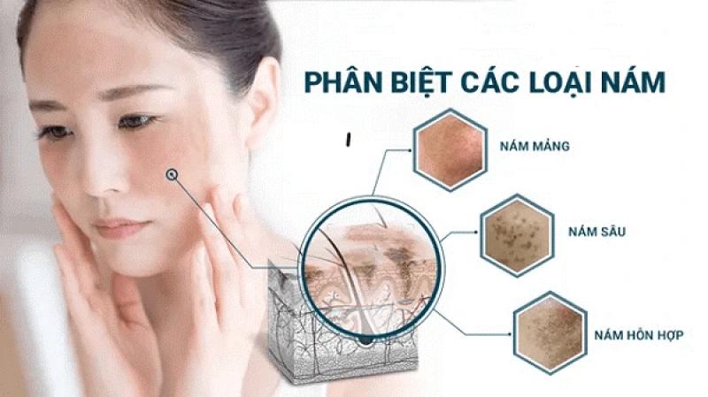 Gợi ý cách trị nám chân sâu, nám mảng... hiệu quả tại nhà không cần xâm lấn- Ảnh 2.