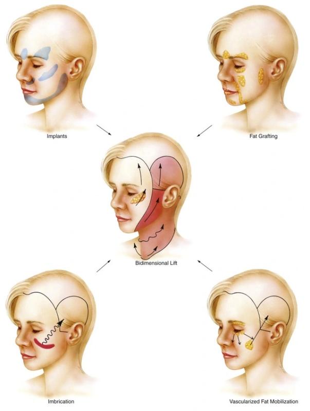 Căng da mặt không sẹo, tương lai của trẻ hóa da mặt không dao kéo- Ảnh 2. Căng da mặt không sẹo, tương lai của trẻ hóa da mặt không dao kéo- Ảnh 2.