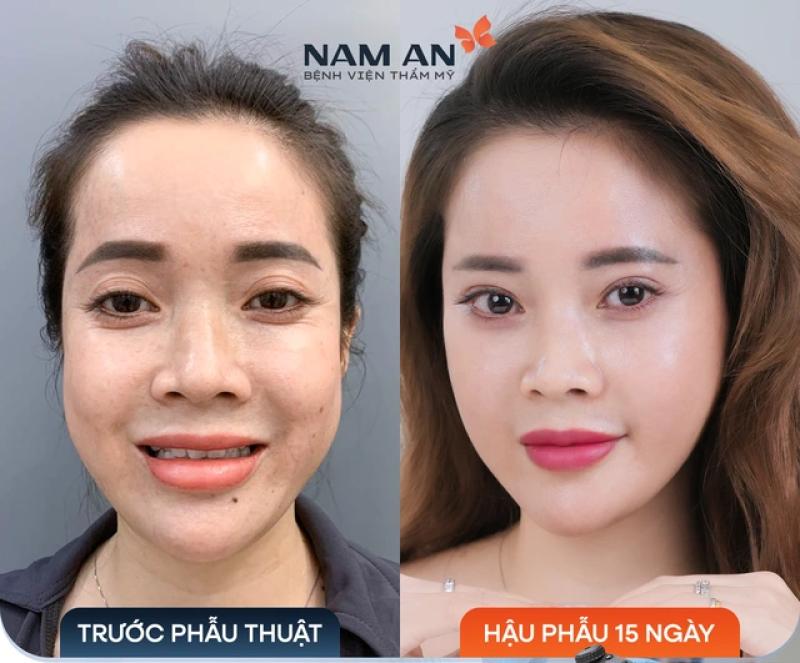 Bệnh viện thẩm mỹ Nam An – Địa chỉ căng da mặt nội soi uy tín - Ảnh 3.