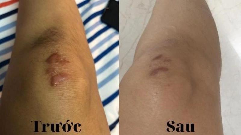 Review miếng dán xóa mờ sẹo lồi Rejuvaskin Scar FX tốt không và nơi mua chính hãng- Ảnh 6.