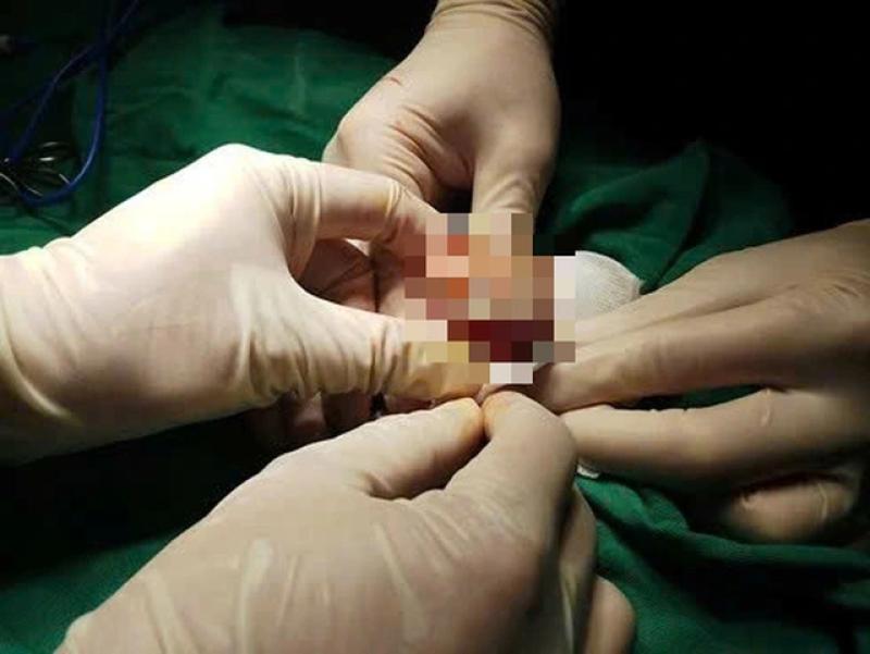 6 dấu hiệu cảnh báo ung thư dương vật- Ảnh 1. ung thư dương vật