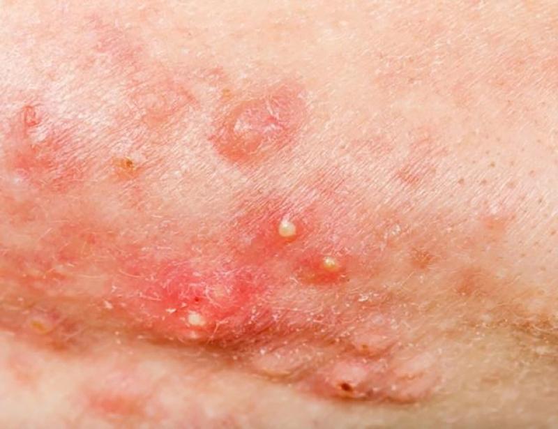 Scar Esthetique: Giải pháp kích tăng sinh collagen cho sẹo lõm mịn da- Ảnh 2.