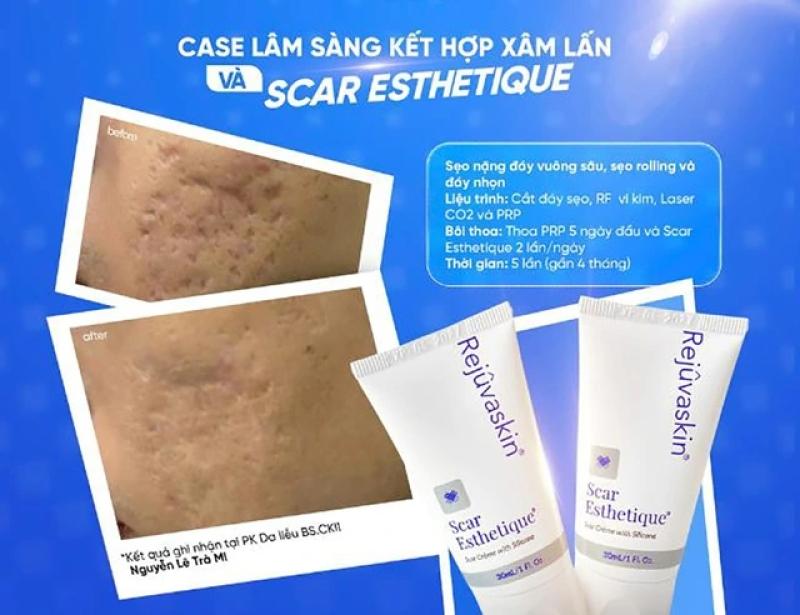 Scar Esthetique: Giải pháp kích tăng sinh collagen cho sẹo lõm mịn da- Ảnh 7.