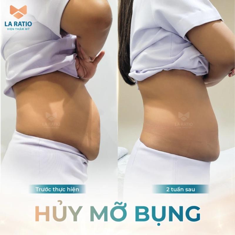 Bí quyết giảm béo nhanh chóng, an toàn với công nghệ Body Slim tại La Ratio- Ảnh 1.