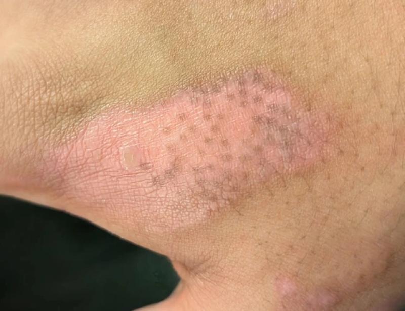 Vai trò các thành phần chống ô xy hóa trong kem trị sẹo thâm- Ảnh 2.