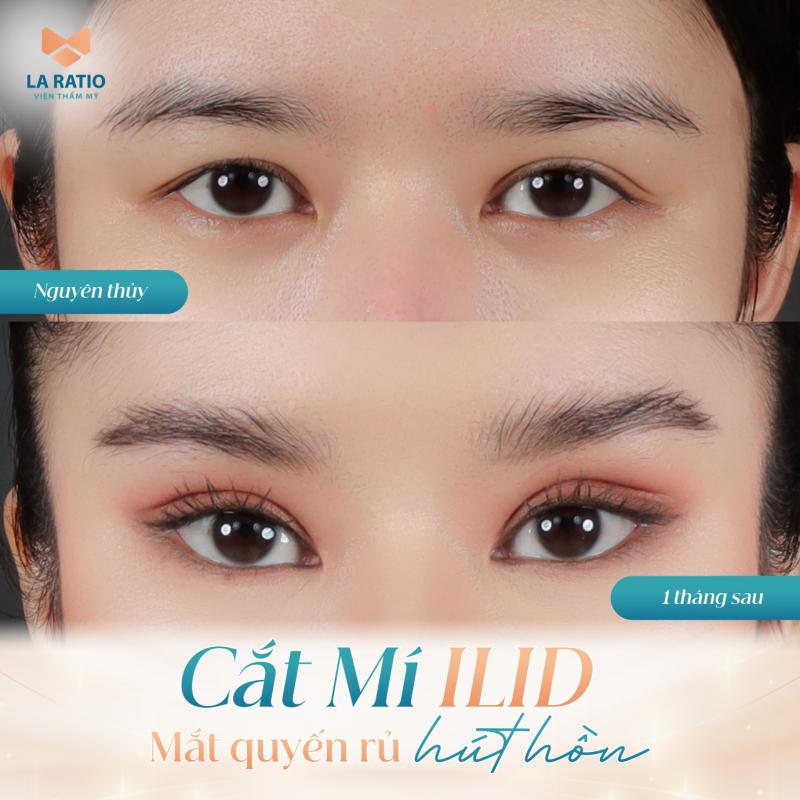 Sở hữu ánh mắt nàng thơ tại La Ratio, công nghệ cắt mí ILID an toàn- Ảnh 1.
