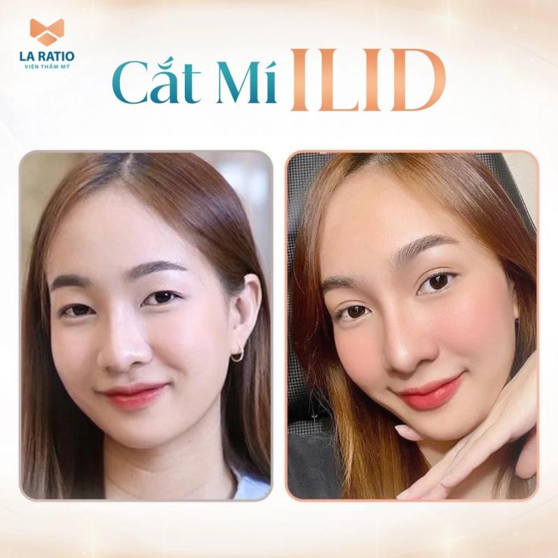 Sở hữu ánh mắt nàng thơ tại La Ratio, công nghệ cắt mí ILID an toàn- Ảnh 3.