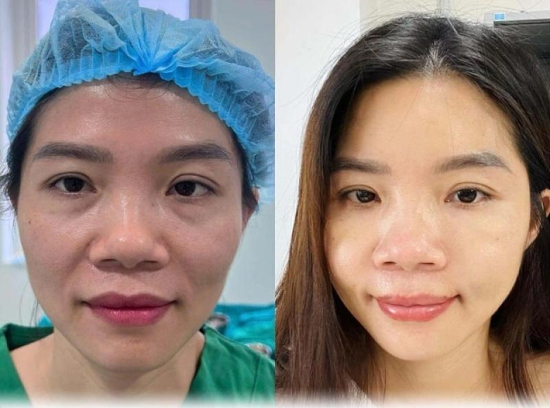 Làm đẹp với mỡ: Khắc phục mọi khuyết điểm cùng bác sĩ CK1 Tạ Trung Kiên- Ảnh 5.