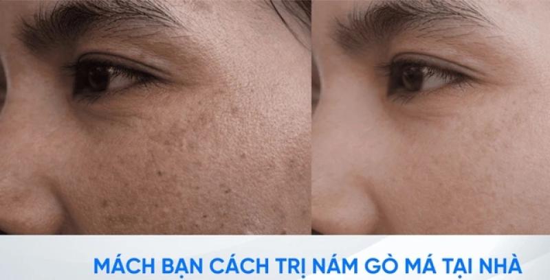Làm thế nào để trị nám gò má dứt điểm ngay tại nhà, không xâm lấn? - Ảnh 1.