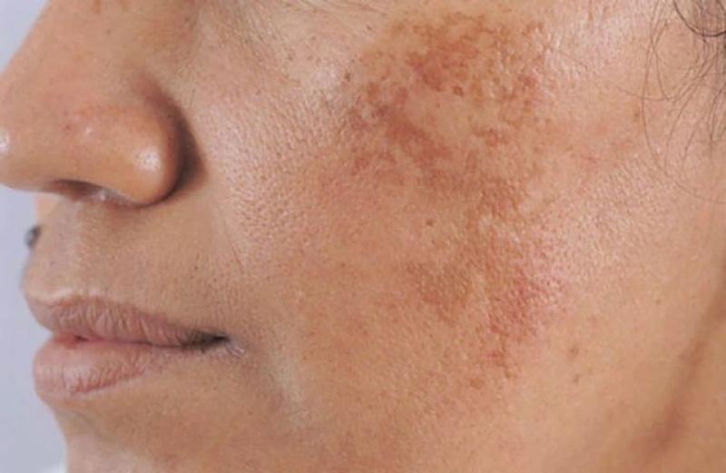 Làm thế nào để trị nám gò má dứt điểm ngay tại nhà, không xâm lấn? - Ảnh 2.
