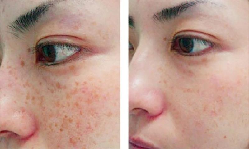 Làm thế nào để trị nám gò má dứt điểm ngay tại nhà, không xâm lấn? - Ảnh 3.