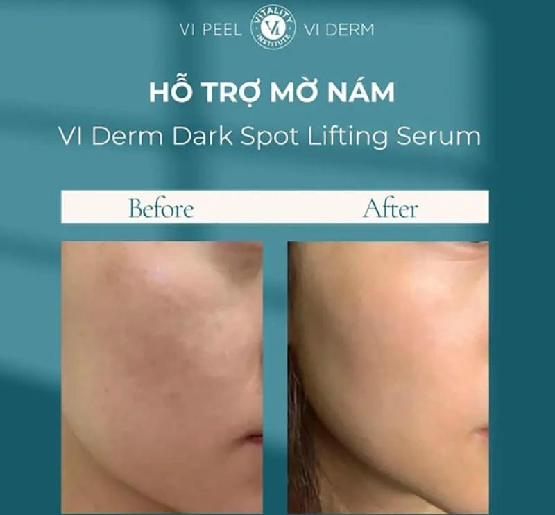 Làm thế nào để trị nám gò má dứt điểm ngay tại nhà, không xâm lấn? - Ảnh 6.