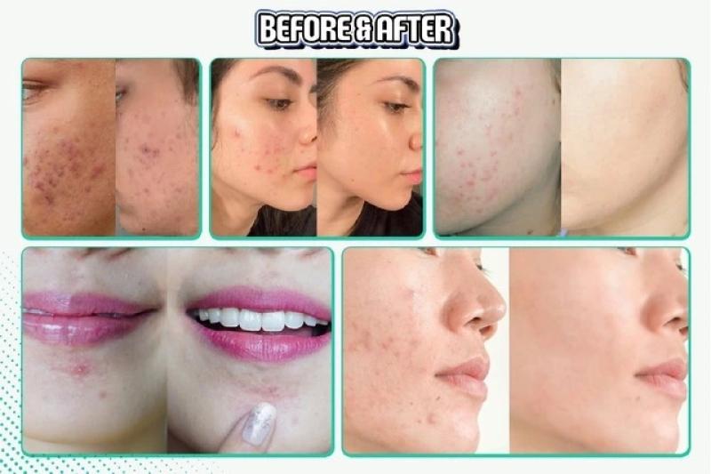 Trị mụn cấp tốc có thực sự an toàn? Lợi ích và tác hại bạn cần biết- Ảnh 1.