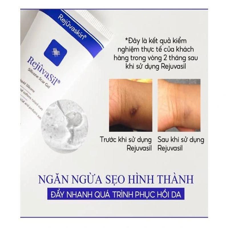 Cách ngừa sẹo và trị sẹo chuẩn y khoa hiệu quả tại nhà không cần xâm lấn - Ảnh 1.