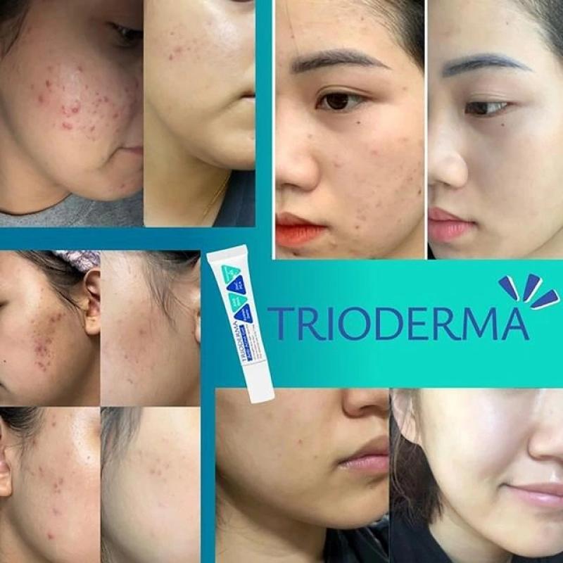 Top 4 kem trị mụn giá rẻ mà hiệu quả với cả mụn thể nặng - Ảnh 1.
