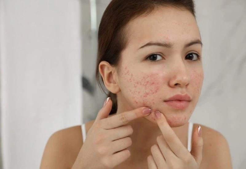 Có cách nào trị thâm sẹo lâu năm hiệu quả tại nhà, tốn ít chi phí?- Ảnh 2. Có cách nào trị thâm sẹo lâu năm hiệu quả tại nhà, tốn ít chi phí?- Ảnh 2.
