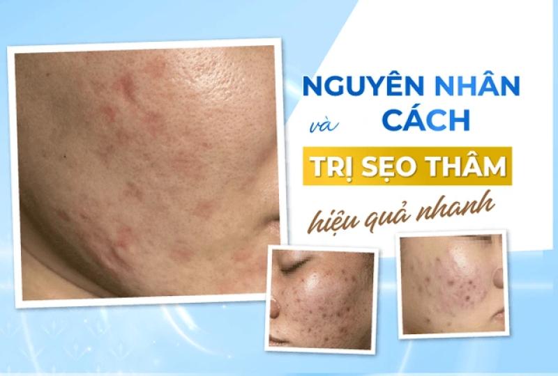 Có cách nào trị thâm sẹo lâu năm hiệu quả tại nhà, tốn ít chi phí?- Ảnh 3. Có cách nào trị thâm sẹo lâu năm hiệu quả tại nhà, tốn ít chi phí?- Ảnh 3.