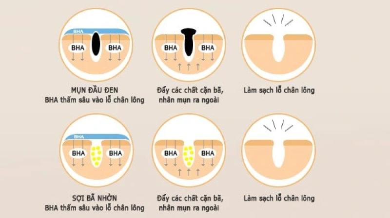 BHA là gì? Vì sao trở thành ngôi sao trong các sản phẩm trị mụn? - Ảnh 4.