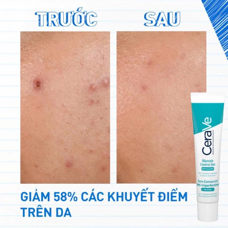 Top 4 kem trị mụn giá rẻ mà hiệu quả với cả mụn thể nặng - Ảnh 5.