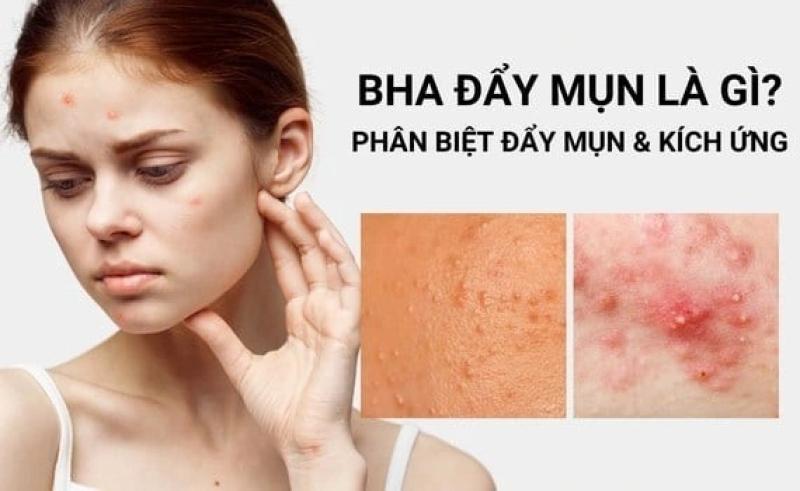 BHA là gì? Vì sao trở thành ngôi sao trong các sản phẩm trị mụn? - Ảnh 5.