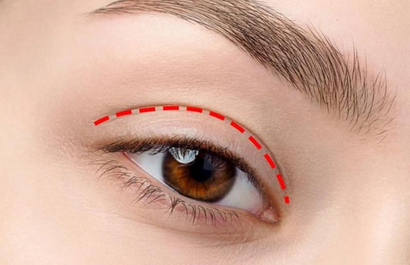 Vết thâm tiểu phẫu không chịu hết? Đây là mẹo chăm chuyên gia hay dùng! - Ảnh 1.