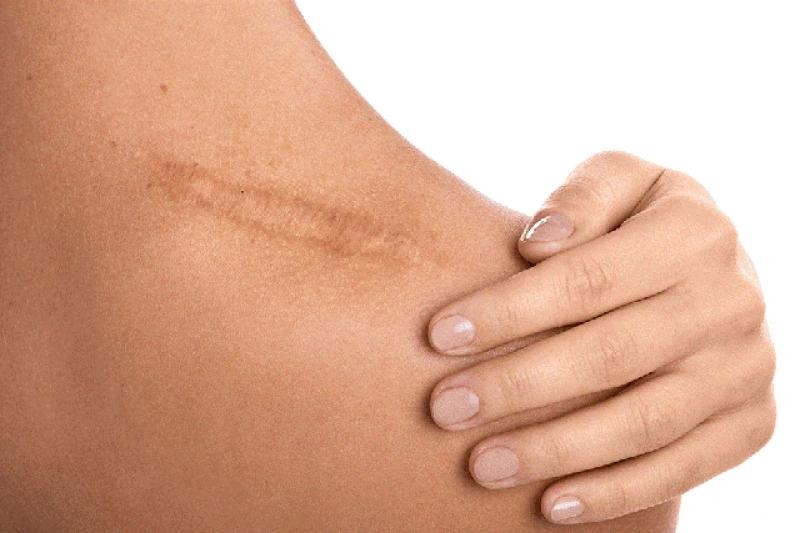 Chăm sóc và điều trị sẹo lồi tại nhà bằng các sản phẩm dược mỹ phẩm- Ảnh 2.