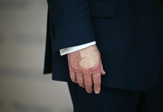 Dấu vết lạ xuất hiện trên mu bàn tay Tổng thống Trump - Ảnh 1.