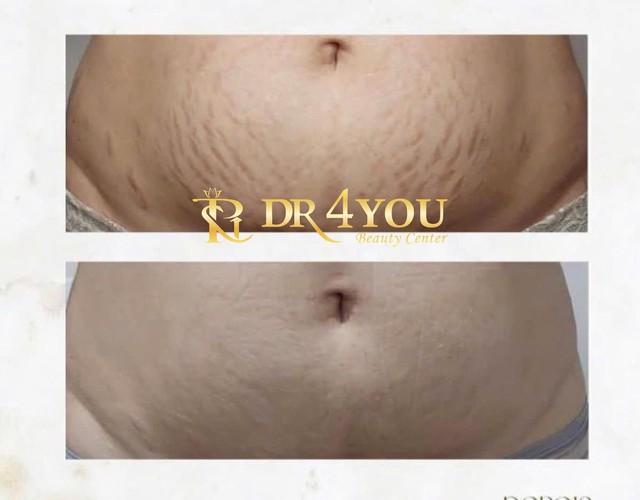 Khám phá 7 lợi ích tuyệt vời của công nghệ Plasma Lạnh trong thẩm mỹ- Ảnh 5.