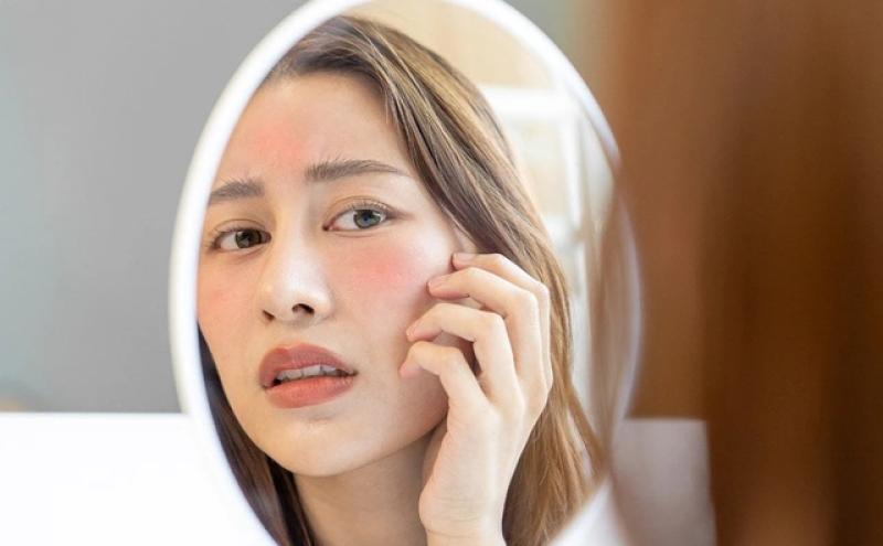 Top 7 sản phẩm làm dịu da đỏ, kích ứng sau laser hiệu quả- Ảnh 1. Top 7 sản phẩm làm dịu da đỏ, kích ứng sau laser hiệu quả- Ảnh 1.