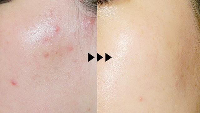 Top 5 kem giảm mụn viêm sưng xẹp nhanh, ngăn tái phát và ngừa sẹo hiệu quả- Ảnh 1.