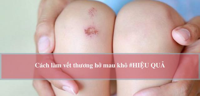 Hướng dẫn cách làm vết thương hở mau khô, nhanh lành và ngừa sẹo ngay tại nhà- Ảnh 1.