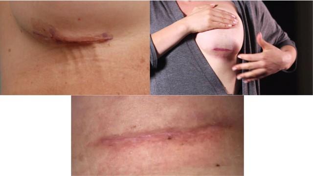 Cách chăm sóc vết thương sau phẫu thuật ngực chuẩn y khoa ngừa sẹo tối đa - Ảnh 2.