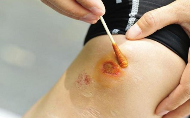 Hướng dẫn cách làm vết thương hở mau khô, nhanh lành và ngừa sẹo ngay tại nhà- Ảnh 2.