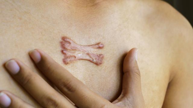 Sẹo lồi: Nguyên nhân và cách điều trị với cả sẹo lâu năm, ngừa tái phát - Ảnh 3.
