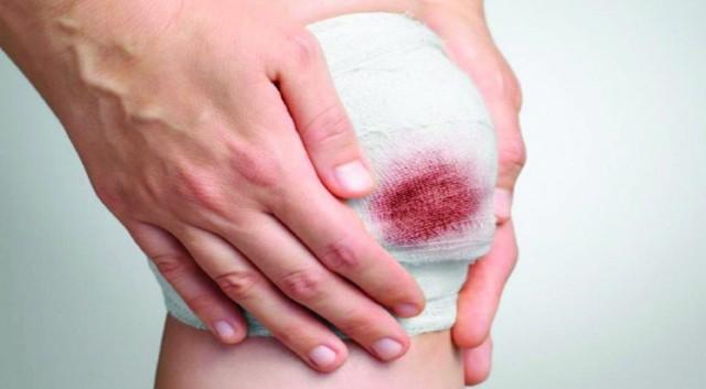 Hướng dẫn cách làm vết thương hở mau khô, nhanh lành và ngừa sẹo ngay tại nhà- Ảnh 3.