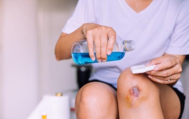 Hướng dẫn cách làm vết thương hở mau khô, nhanh lành và ngừa sẹo ngay tại nhà- Ảnh 4.