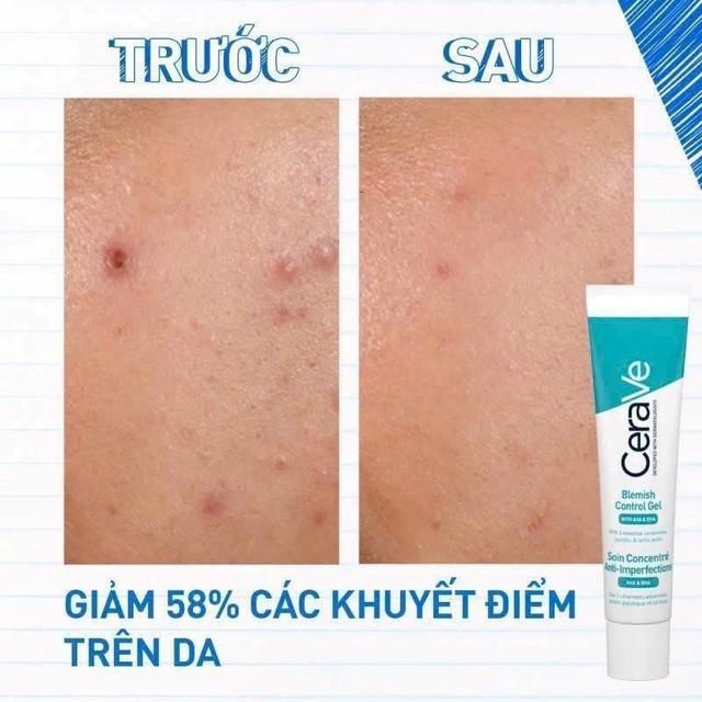Top 5 kem giảm mụn viêm sưng xẹp nhanh, ngăn tái phát và ngừa sẹo hiệu quả- Ảnh 5.