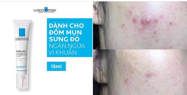 Top 5 kem giảm mụn viêm sưng xẹp nhanh, ngăn tái phát và ngừa sẹo hiệu quả- Ảnh 8.