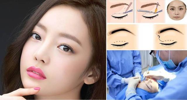 Chia sẻ cách chăm sóc vết thương sau cắt mí ngăn ngừa sẹo xấu từ chuyên gia - Ảnh 1.