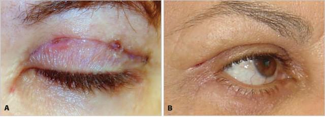 Chia sẻ cách chăm sóc vết thương sau cắt mí ngăn ngừa sẹo xấu từ chuyên gia - Ảnh 2.
