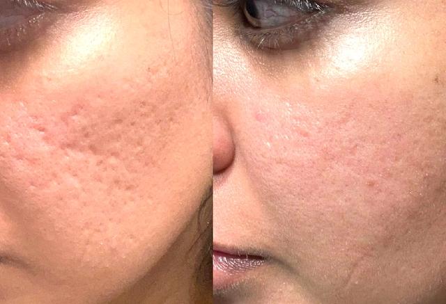 Nguyên tắc vàng trong chăm sóc sẹo: Điều mà nhiều người Việt đang bỏ qua - Ảnh 1.