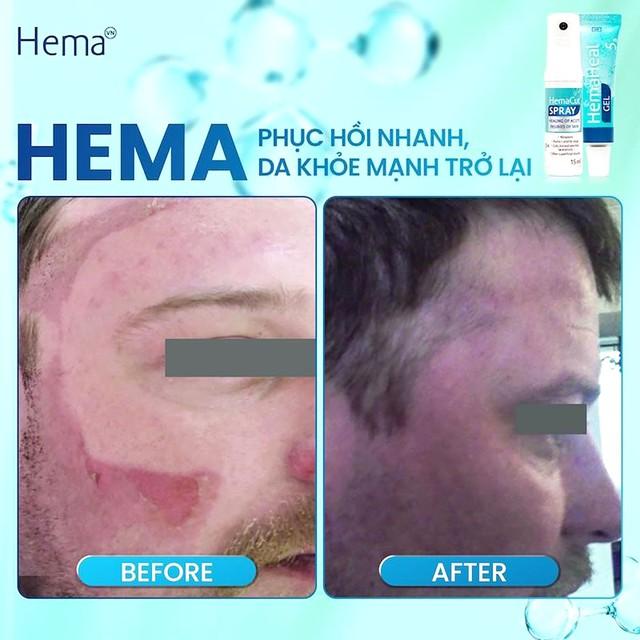 Hema - Tác động sâu vào tiến trình lành thương- Ảnh 4.