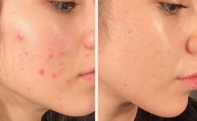 Top 12 kem trị mụn dứt điểm cả mụn thể nặng mà không thâm, không kích ứng - Ảnh 1.