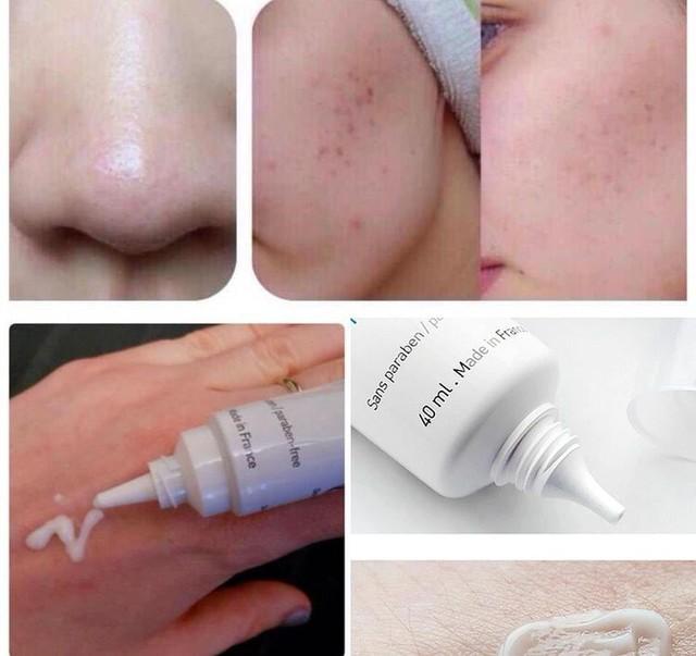 Top 12 kem trị mụn dứt điểm cả mụn thể nặng mà không thâm, không kích ứng - Ảnh 6.