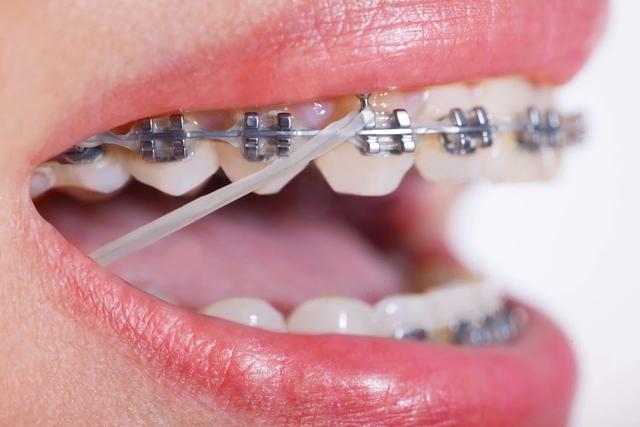 Niềng răng có đau không? Giai đoạn nào đau nhất?- Ảnh 4.