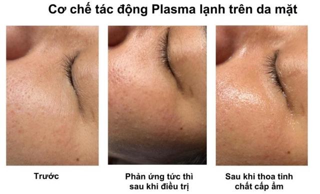 Hướng dẫn sử dụng máy Plasma Gold trong làm đẹp trị sẹo hiệu quả tối ưu - Ảnh 11.
