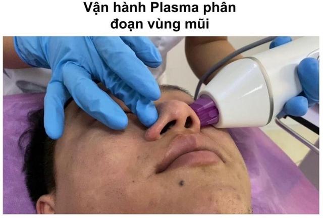 Hướng dẫn sử dụng máy Plasma Gold trong làm đẹp trị sẹo hiệu quả tối ưu - Ảnh 15.