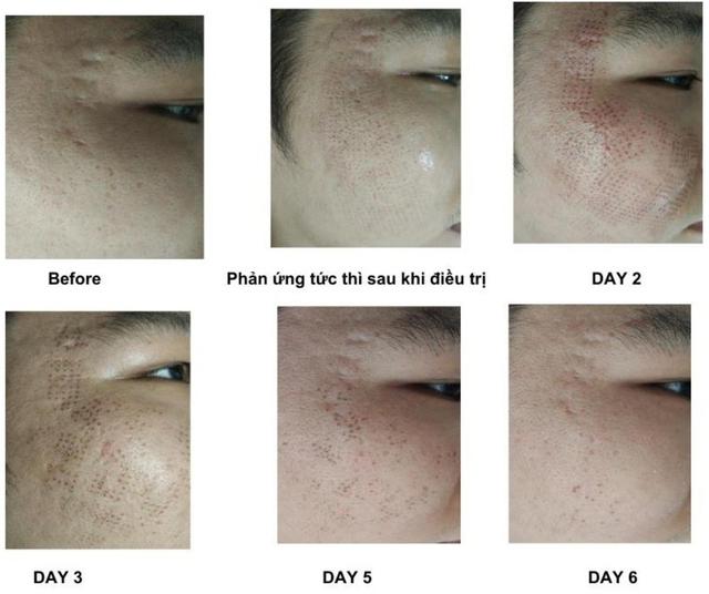 Hướng dẫn sử dụng máy Plasma Gold trong làm đẹp trị sẹo hiệu quả tối ưu - Ảnh 16.